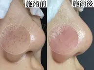 【新規限定8,800円】毛穴エクストラクションプロ✨黒ずみ・角栓すっきり改善×Before/After撮影OK📷