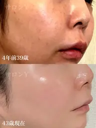 業界最高峰★グリーンピール5days★(5日後のアフタートリートメント込み)下記の専用メニューと一緒にご予約下さい。