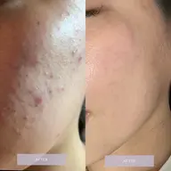 【平日のみ】韓国式🇰🇷剥離ありハーブピーリング🌿