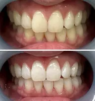 【初回限定⭐︎特別価格】黄ばみや汚れをごっそり落とす◎（8分×2照射）