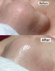 \てかり毛穴/毛穴洗浄xヒアルロン酸保湿導入60分|“整える”最強コンビ