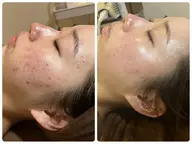 【🌸ミニモ学割🌸垢抜けたい女子必見‼️毛穴フェイシャル】毛穴の黒ずみ・角栓・ニキビケア👃🏼