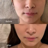 ハイドラ&セラピール