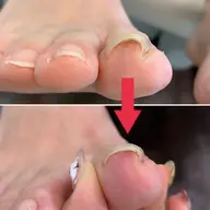 【Foot】巻き爪トラブルケア