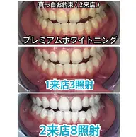 【初回限定・白さを極める】真っ白お約束🦷プレミアムホワイトニング❣️〈合計8回照射2来店〉❣️😌✨