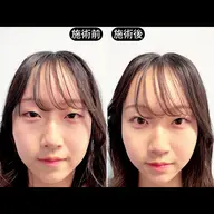 【目元&頭重ケア】ヘッドスパ鍼×電気×小顔美容鍼