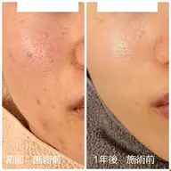 【ゴワつき】角質除去ピーリング+毛穴洗浄&血流リンパマッサージ+美容液導入