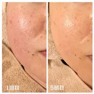 【毛穴縮小/シワ/たるみ】レチノールピール+毛穴洗浄&血流リンパマッサージ+美容液導入