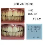 セルフホワイトニング8分×2回
