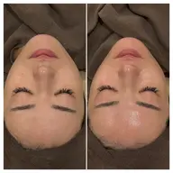 ツヤ爆誕⚡️第5世代ピーリング💆🏻‍♀️敏感肌の方も安心して受けられる陶肌ピール❣️ピーリングが初めての方にも◎