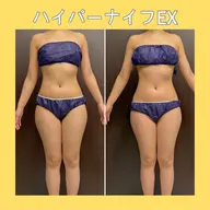 ハイパーナイフEXお好きな2パーツ当て放題❤️初めての方も安心👐気になるパーツだけケアしたい方に🔥