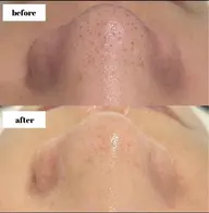 ハイドラフェイシャル(毛穴洗浄)   鼻周りのみのため全顔希望の方はお申し付けください✨