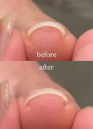 10名限定【ケア➕プレート】巻き爪ケア