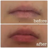 【エステ】リップエステ👄