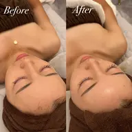 REVIハーブピーリング　全顔