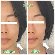 【エラ集中ケア】ゆるめてほぐして、なだらかなフェイスラインへ整えます