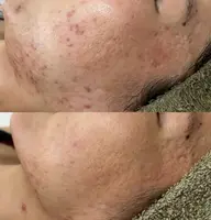 【クレーター毛穴開き】剥けないハーブピーリング+ダウンタイムなしエステダーマ(お持ち帰り美容液付き) 定価27,500円