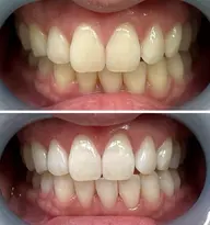 【初回ご新規様限定】スタンダードコース​〜​黄ばみや汚れをごっそり落とす​〜​　15分×2照射