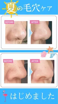 毛穴洗浄(ハイドロスプラッシュ、水素水を使った毛穴洗浄)さらにワックスと組み合わせで産毛をなくしツヤツヤで美しい肌に✨✨