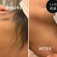 うなじ美人へ✨襟足脱毛