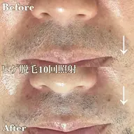 【人気No.1】メンズヒゲ脱毛 まずはお試し ¥1,980