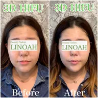 【平日 11:00～15:00限定】 ✨メスを使わないウルトラプラス３Dリフトアップ✨￥19800⇒￥7800