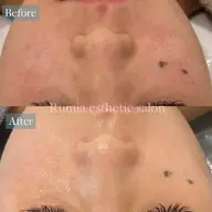 ミニモSALE✨芸能人御用達の肌管理ピーリング🌿クリスティーナ【アンストレス/ミューズ】3回49,500→19,800