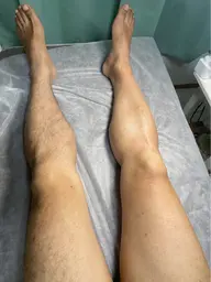 【男性】両足ALL　ワックス脱毛