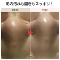 ✨人気✨毛穴洗浄ハイドロピーリング！長年の毛穴の黒ずみ＆角栓を解消♪さらに美容液導入でもっちり肌へ☆60分3980円