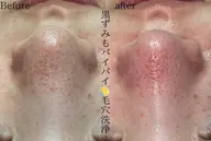 【初回限定】毛穴洗浄Tゾーンコース　メンズにもおすすめ！