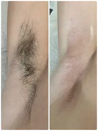 ムダ毛スッキリ！蒸れ知らず♪脇ワックス