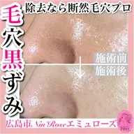 毛穴プロの極上毛穴美肌コース