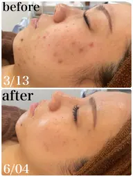 【集中8回】肌コンディションを整えたい方に｜週1プライベート肌ケア