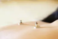 【冷え性、手足の冷え】からだぽかぽか鍼灸【季節限定】