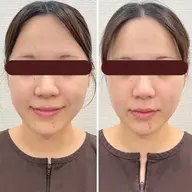 平日限定【むくみ/エラ張り/左右差】初めての小顔矯正60分⭐️フェイスライン