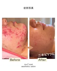 【もう辛いとは言わせない‼️】本気で悩んでいるなら当店人気No.1剥離ありハーブピーリング🌿治せないニキビは無い