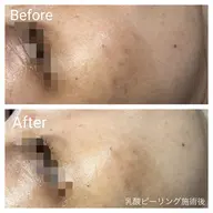 🌼冬のくすみやスキンケアの浸透率UPに🌼お肌に優しい低刺激乳酸ピーリングフェイシャル60分