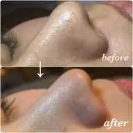 《フェイシャル》毛穴ケアコース