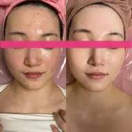 【極上✨艶肌フェイシャル】ヒト幹細胞美容液使用＋フェイシャルケア♡潤い・ハリ・艶✨※年齢に応じたケア