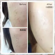 【シミケア30分取り放題】🌸毛穴洗浄×ポレーション（美白&保湿美容液）×シミケア30分