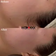 顔ワックス脱毛【比較写真撮らせてくれる方限定】先着5名様☆