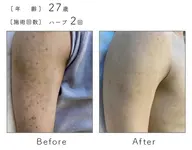 【二の腕ニキビ・毛孔性苔癬】ハーブピーリング