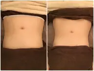 ○痛くないセル脂肪ケア (お腹)