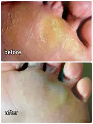 フットケア(足裏角質除去)