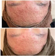 【本気のニキビケア】ハーブピーリング×幹細胞ポレーション入込み×水分パック ニキビ/ニキビ跡/肌荒れ/潤い/毛穴ケア