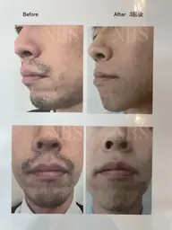 メンズ顔、ひげまとめて　　　　　　　　　　　　　　　　　　　　　　　　　　　　　　　何度でも1回3000円‼︎👨👑✨