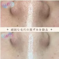 ⭐️人気No.1⭐️即効果実感❣️【頑固な黒ずみ・角質角栓に⭐️】最新浮かせる毛穴洗浄フェイシャル70分コース