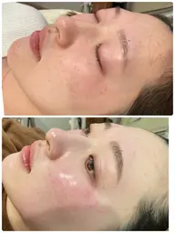 フェイシャルワックス（全顔）