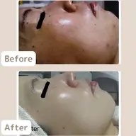人気NO.1✨《繰り返すニキビにお悩みの方》社会人🈹本気のニキビケア2回体験　[大阪城北詰/京橋駅]