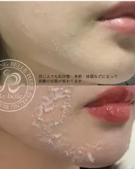 【リベル】ハーブピーリング🌿《顔》最強肌質改善ケア✨(剥離あり)